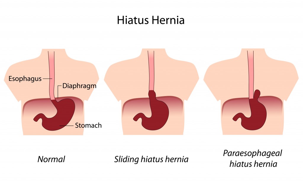 Hiatal hernia anxiety symptoms